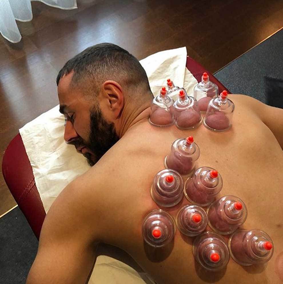 Ventosaterapia o cupping