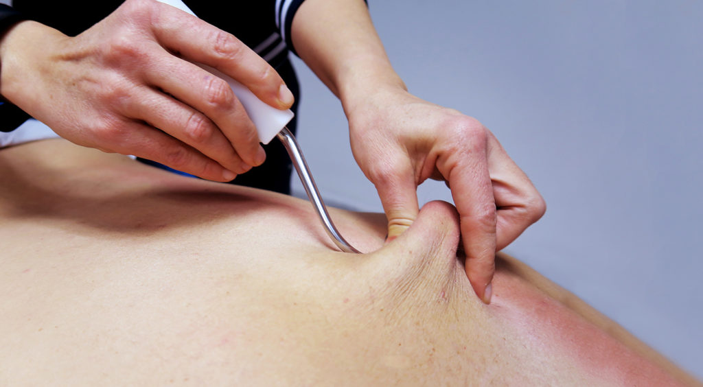 Fibrolisis Instrumental Miofascial ganchos tratamiendo fisioterapia